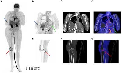 Long axial field of view PET/CT in critically ill patients: lessons from a case report